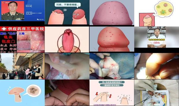 汕头包皮里面白色的是什么