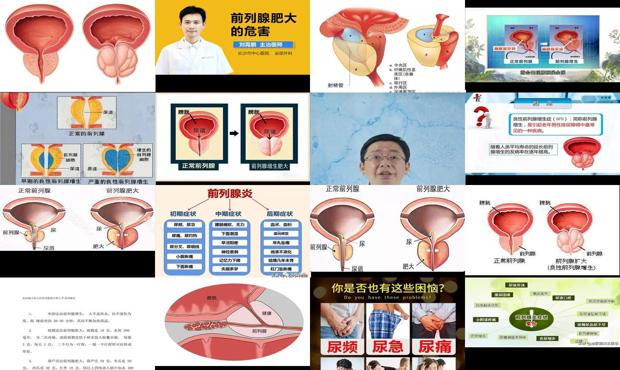 汕头前列腺肥大会不会很容易复发