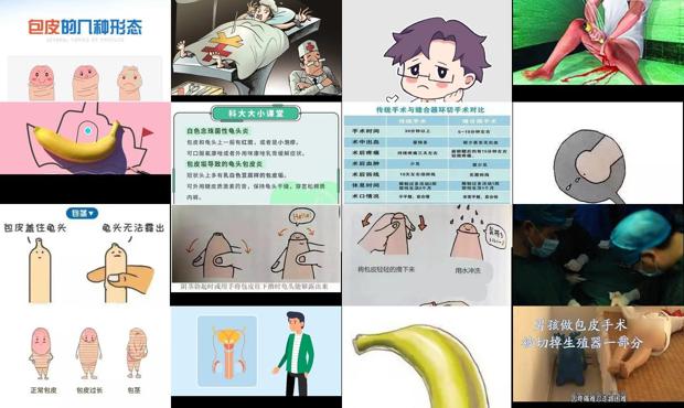 汕头生殖器包皮