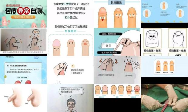 汕头包皮要割吗