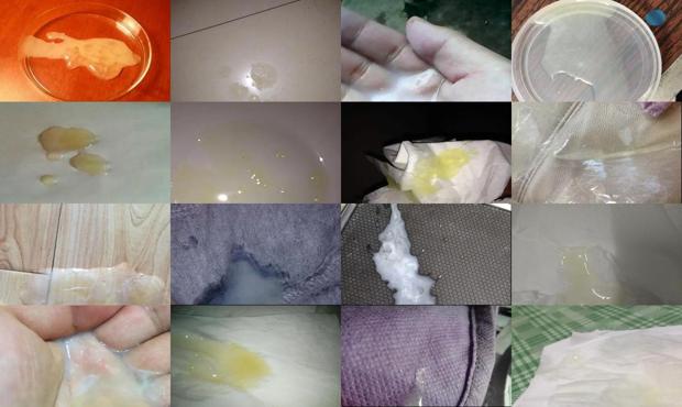 汕头前列腺液精液