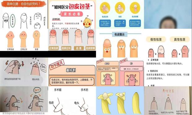 汕头如何判断包皮是否过长