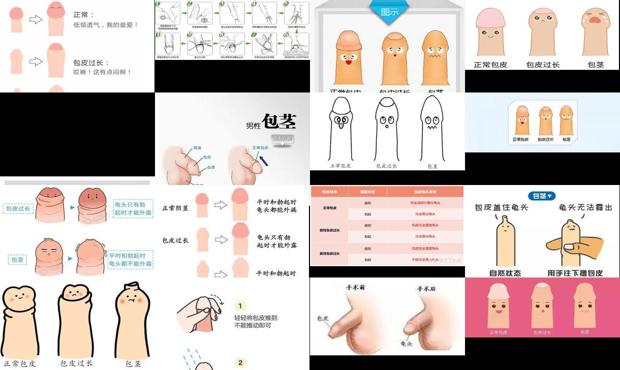 汕头正常包皮