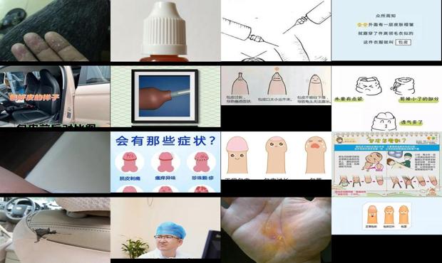 汕头包皮掉皮