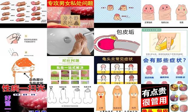 汕头包皮内*不洗*一层白垢