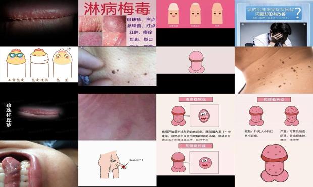 汕头包皮上长肉粒