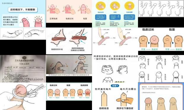 汕头割包皮后勃起怎么办