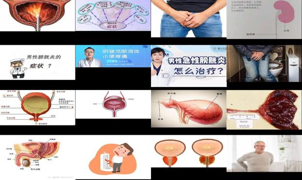 汕头男人膀胱炎症状