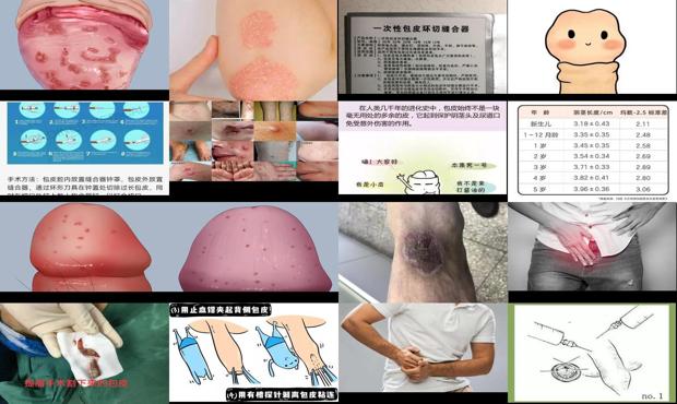 汕头包皮炎症状对照图片图