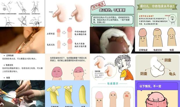 汕头包皮过长有什么
