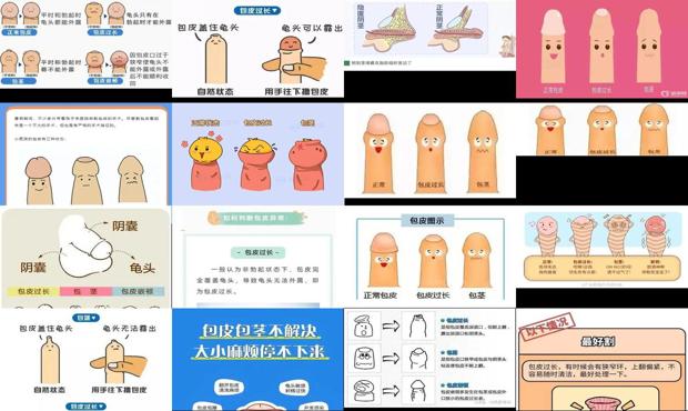 汕头男孩子包皮