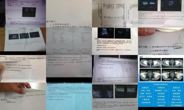 汕头前列腺欠均匀什么意思