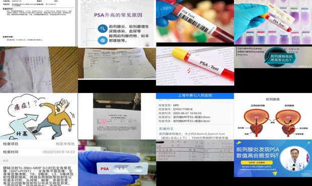 汕头前列腺炎 psa升高 发烧