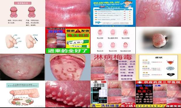 汕头男性包皮炎症状