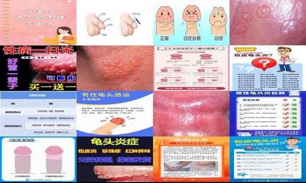 汕头包皮过长龟头炎症状