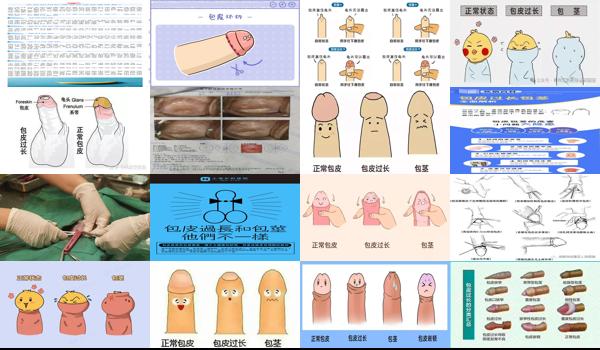 汕头包皮手术多少钱 - 汕头包皮过长是怎么样