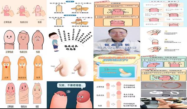 汕头男科医院哪家好一些 - 汕头包皮长不割行吗