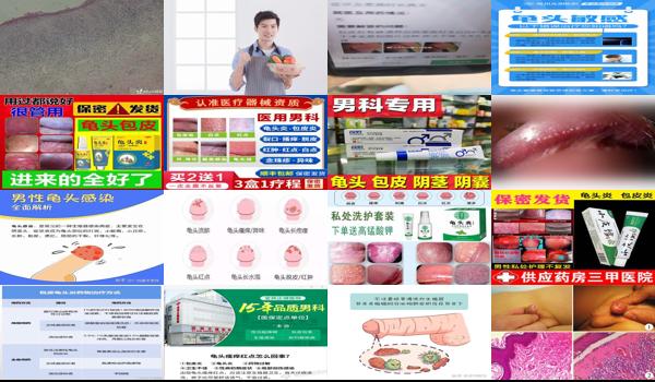 滴虫性包皮炎的主要症状 - 汕头滴虫性包皮龟头炎