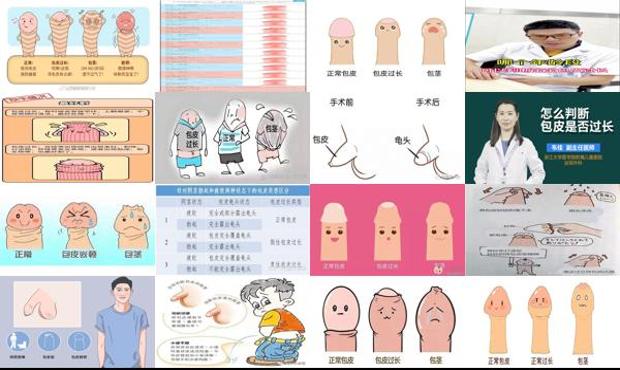 汕头男人如何判断包皮过长