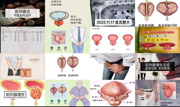 汕头前列腺发炎会怎样