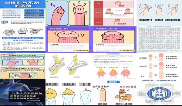 汕头割包皮的医院 - 汕头男人要不要割包皮