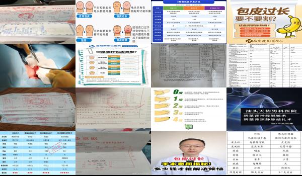 汕头割包皮需要多少钱 - 汕头一般包皮手术多少钱