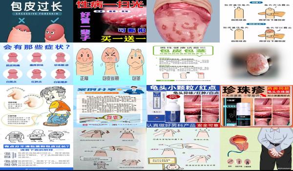 汕头包皮手术多少钱 - 汕头包皮炎症图