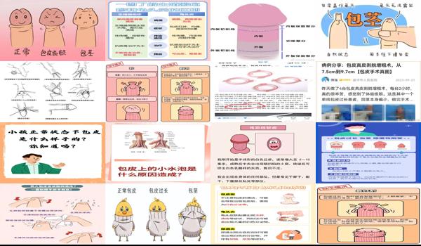汕头包皮手术多少钱 - 汕头包皮是什么东西