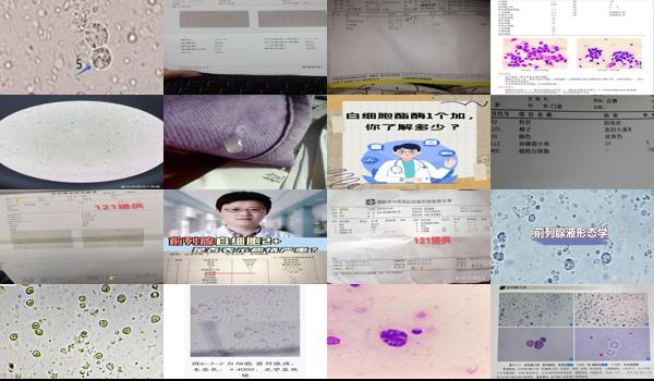 前列腺液白细胞一个加 - 汕头前列腺液白细胞1个加