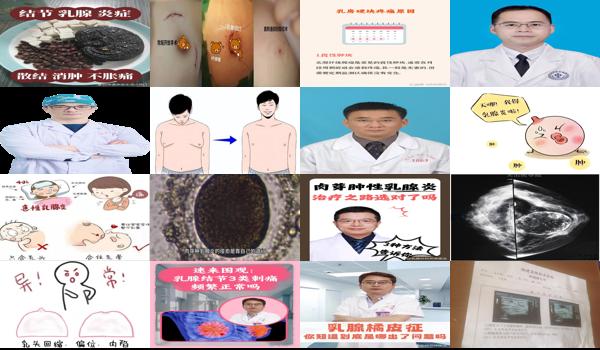 汕头男人乳腺炎症状有哪些 - 汕头男人乳腺炎症状