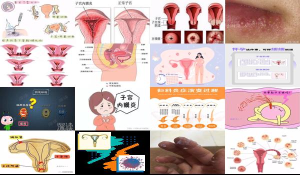 汕头外科医院 - 汕头外阴炎会导致不孕吗