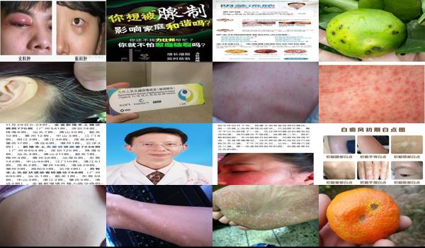 前腺炎的治疗 - 汕头前腺炎症状