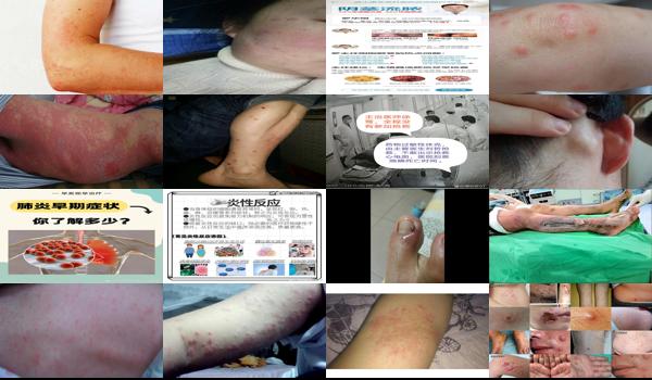 身体发炎发热 - 汕头身体发炎症状