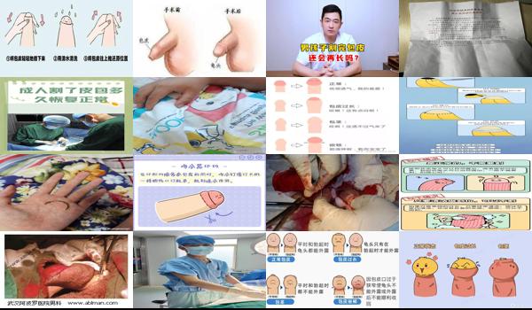 汕头*好的割包皮医院是哪家 - 汕头包皮割完恢复健康样子图片