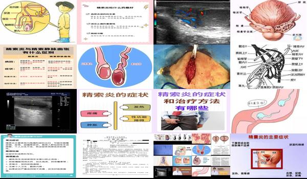 精索炎症怎么治疗 - 汕头精索炎症状